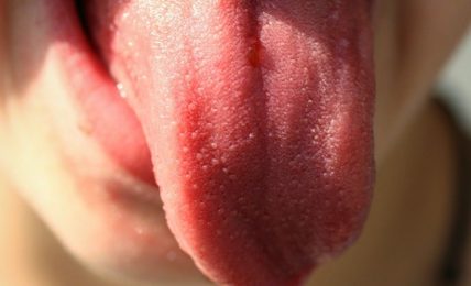 il-rossore-della-lingua-puo-segnalare-una-malattia-pericolosa